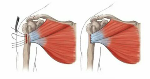 Разрыв большой грудной мышцы